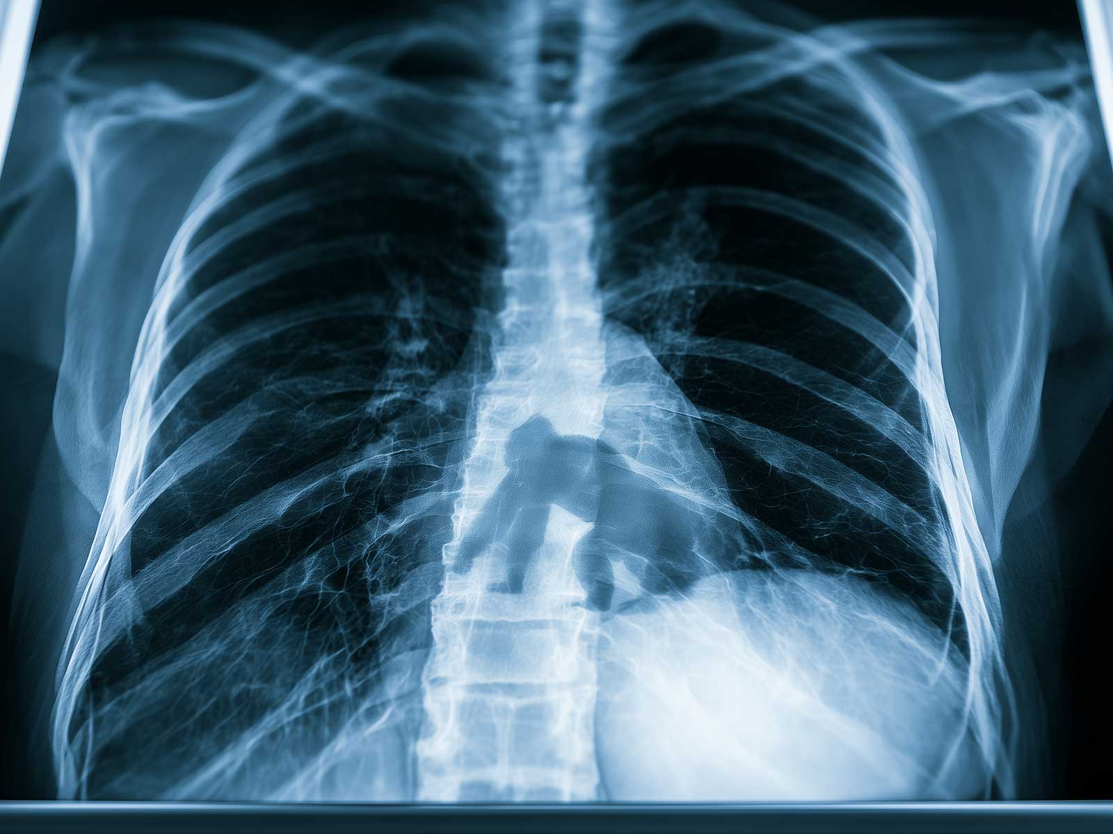 A chest scan on a lightbox with a gorilla shape hidden in the anatomy, echoing the radiology study.